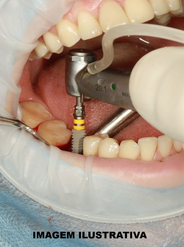 Prefeitura de Bernardino aciona Justiça e busca solução para caso dos implantes dentários