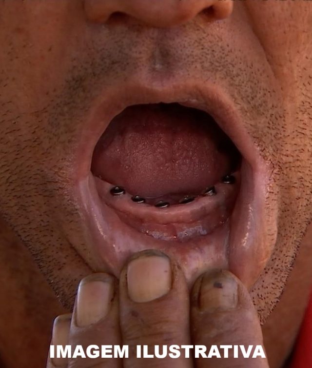 Bernardino de Campos: implantes “gratuitos” deixam moradores sem dentes e com dívidas de até R$ 10 mil